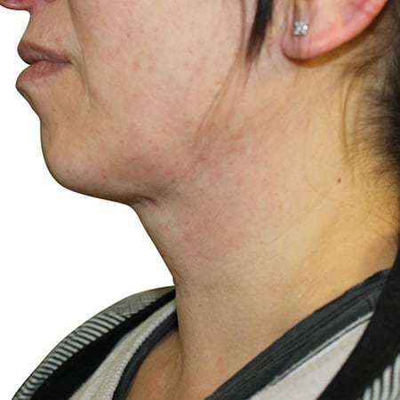 neck-lift-after
